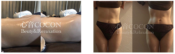 マシン施術写真