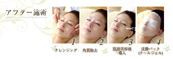 アフター施術